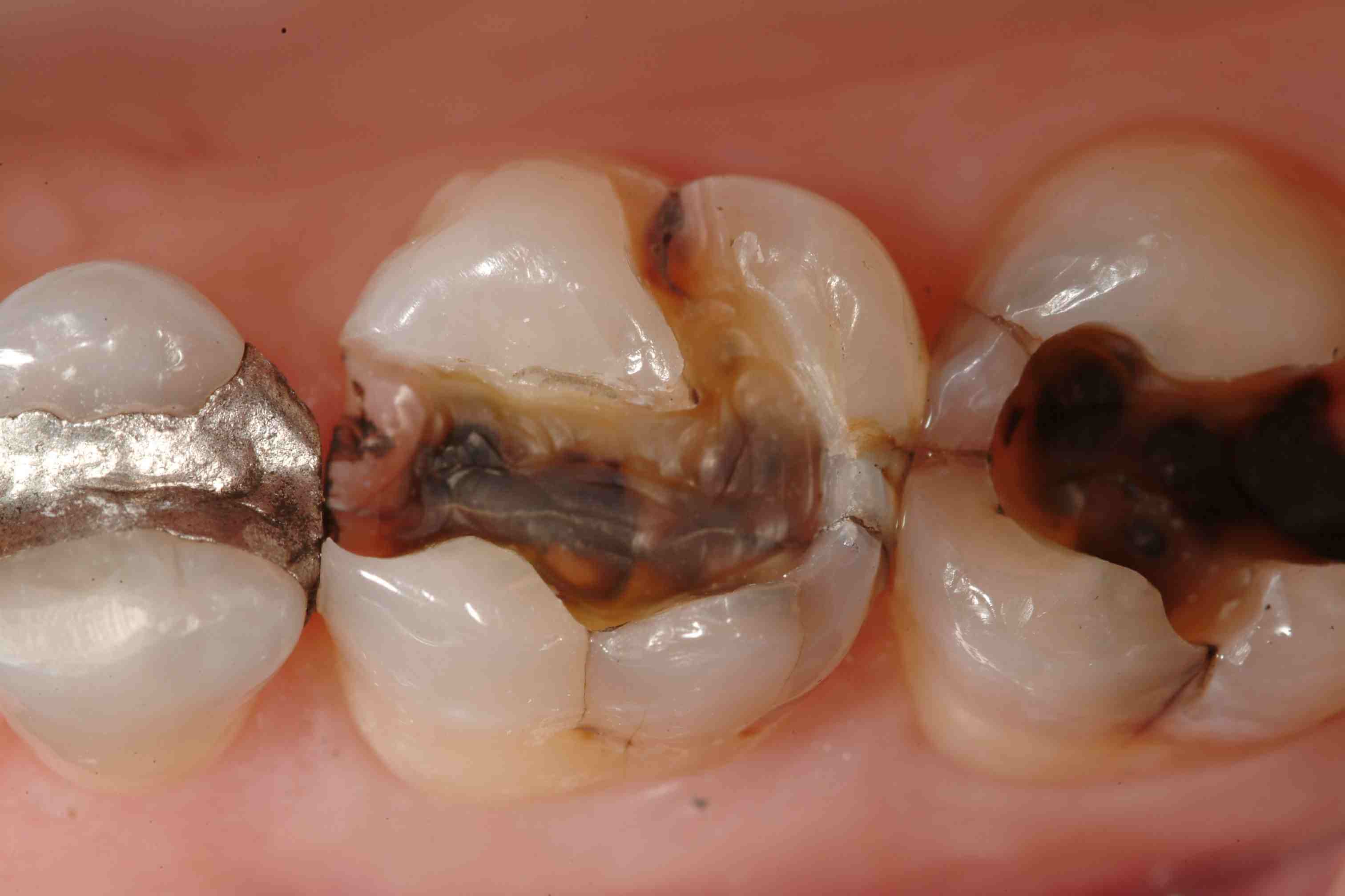 Different Treatment Options For Fractured  Cracked Tooth