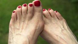 What You Must Know About Bunions