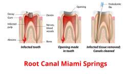 Apple Dental Group : Best Root Canal in Miami Springs, FL