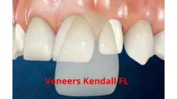 Veneers Kendall FL | Miami Dental Group