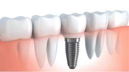 Dental Implants : Advanced Dentistry of Coral Springs