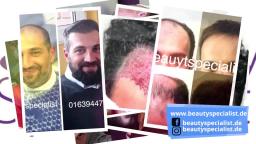 Haartransplantation in istanbul