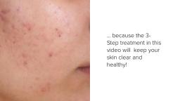Simple Acne Treatment Proven To Work