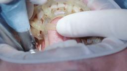 All on Four Dental Implants in South Elgin, IL By Brar Dentistry