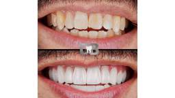 DB Dental Care : Best Teeth Whitening in Miami, FL