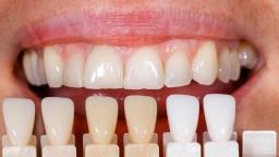 Best Dental Implants In Ocala FL By Ocala Dental Harmony