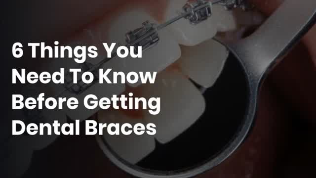6 Things You Need To Know Before Getting Dental Braces