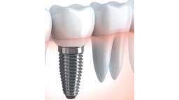 Dental Implants & Periodontal Health in Rochester, NY