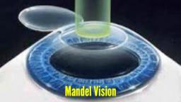 Lasik Manhattan - Mandel Vision (888) 866-3681