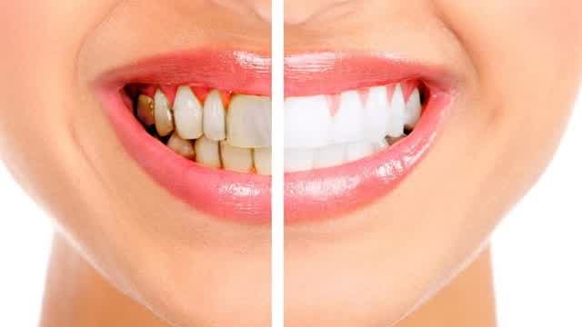 Different Methods To Whiten Your Teeth What You Need To Know