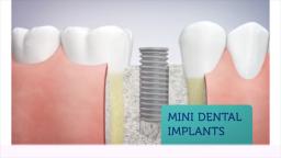 Arlington Dental Associates - Mini Dental Implants in Arlington Heights, IL
