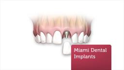 Florida Dental Care of Miller : Affordable Dental Implants in Miami