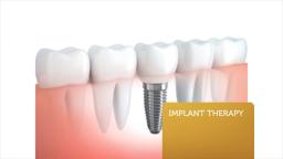 Advanced Dentistry : Dentures in Coral Springs FL