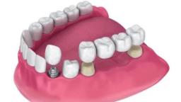 Affordable Full Mouth Dental Implants in San Antonio TX - The Smile Institute