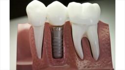 The Glen Dental : Teeth Implants in San Jose