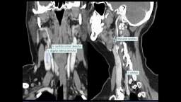 IRRIGACION ARTERIAL CUELLO Y CARA