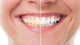 Five Teeth-whitening Myths: Fact or Fiction?