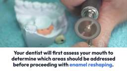 Enamel Reshaping A Non-Invasive Way to Improve Your Smile