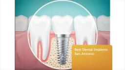 The Smile Institute : Best Dental Implants in San Antonio TX