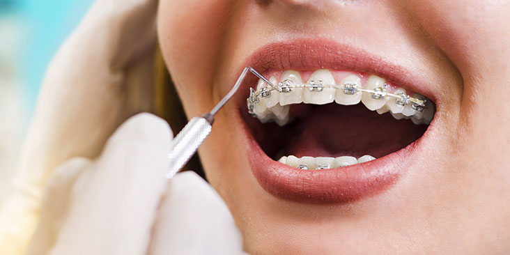 How to Get an Orthodontic Treatment at Home from Your Dentist