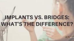 Implants vs. Bridges: What is the Difference?