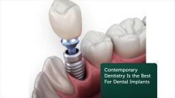 Contemporary Dentistry : Best Dental Implants