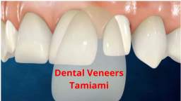 Lujan Dental Veneers in Tamiami, FL