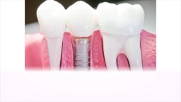 Grand Dental, P.C. - Full Mouth Dental Implants